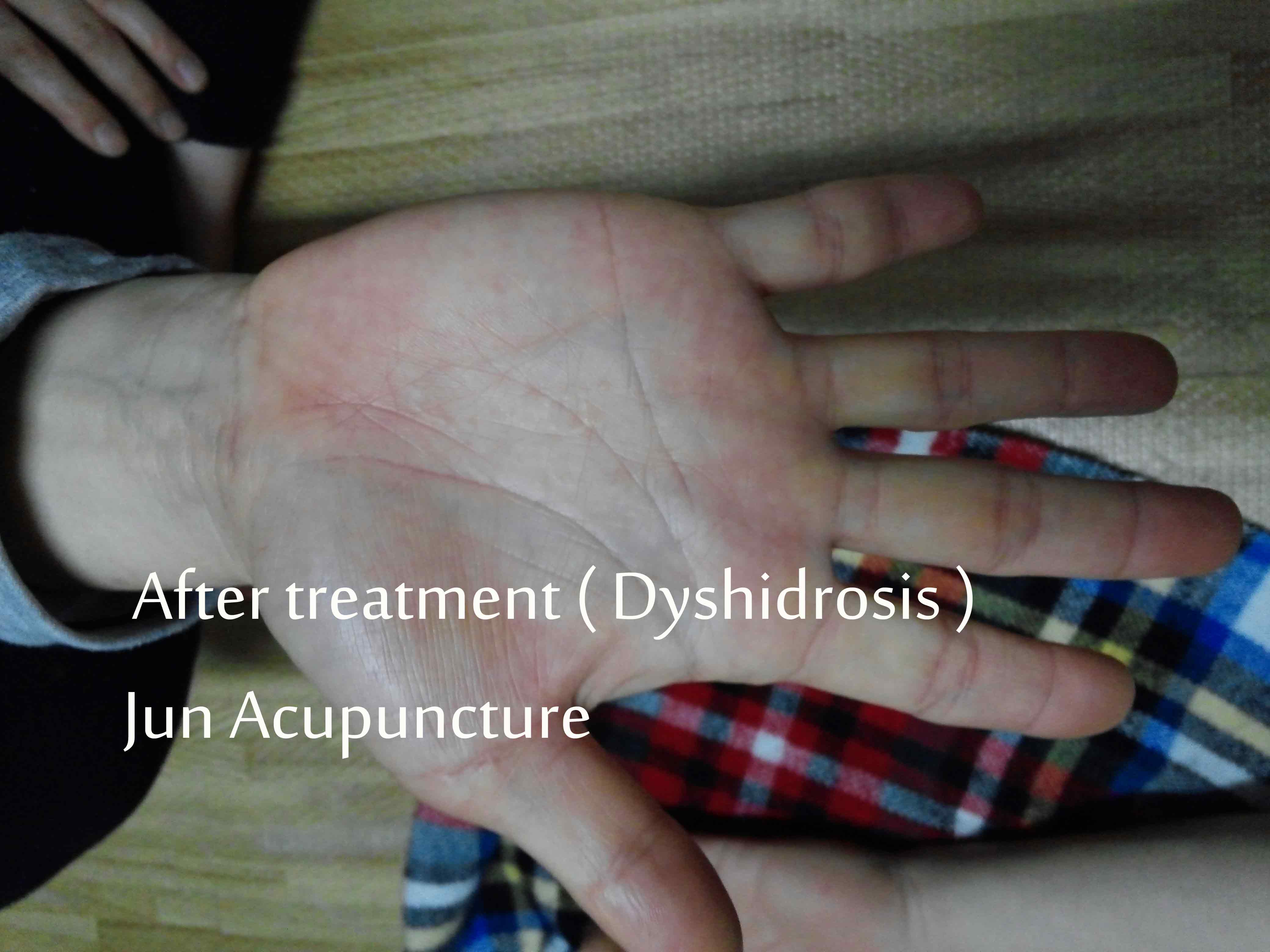 Dyshidrosis